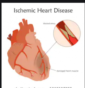 ischemic heart disease