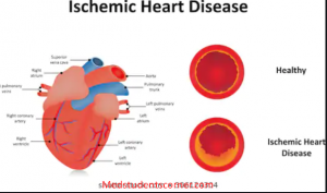 ischemic heart disease notes